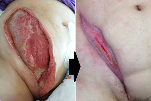Abdominal wall defect 1 day after the third debridement and the wound healing after 20 weeks.