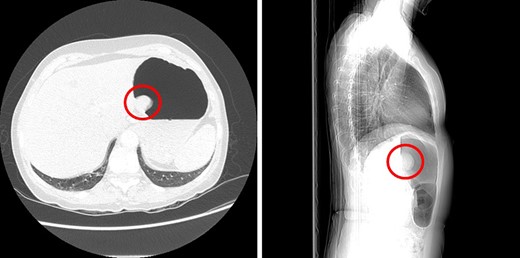 Sagittal and axial CT images showing a large polyp on the posterior gastric wall.