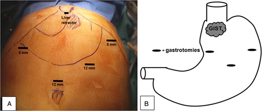 (A) Instrument access points and (B) gastrotomy positions on the anterior stomach wall and GIST location close to the OGJ.