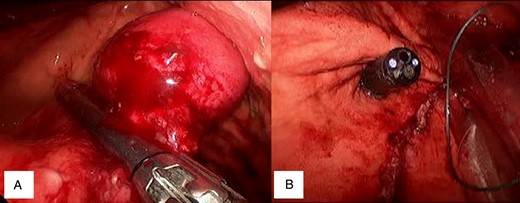 (A) Tumour elevation and stapler placement. (B) Staple line proximity to OGJ.