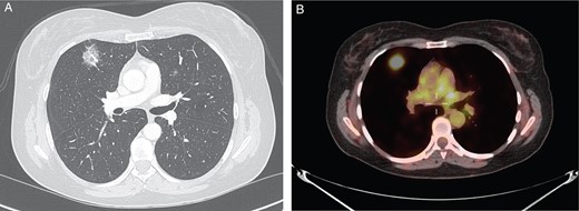 (A) CT chest revealing right upper lobe solid lesion. (B) PET scan of the chest revealing PET-avid right upper lobe lesion.