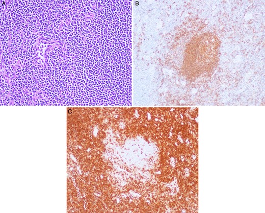 (A) Station 10R lymph node with hematoxylin and eosin (H&E) stain under 20× magnification with many lymphocytes apparent. (B) Station 10R lymph node with CD-20 staining revealing B cells within a reactive germinal center under 20× magnification. (C) Station 10R lymph node with CD-3 staining demonstrating T cells surrounding a reactive germinal center under 20× magnification.