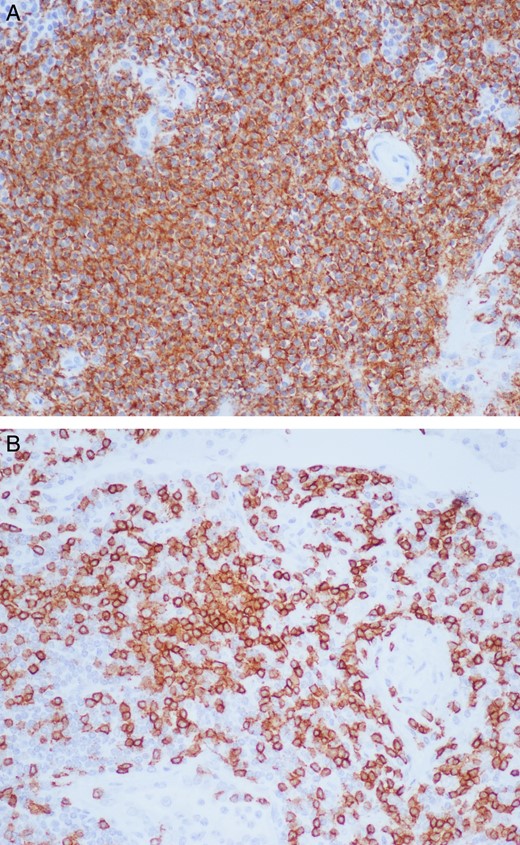 Right upper lobe lung mass under 20× magnification with staining for CD-20 and CD-3 showing a dense lymphoplasmacytic infiltrate mainly consisting of B cells (A) and fewer T cells (B).