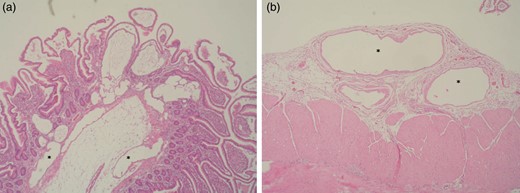 (a) Histopathology of the resected small intestine with dilated subserosal lymph vessels (*). (b) Histopathology of the resected small intestine with dilated submucosal lymph vessels (*).