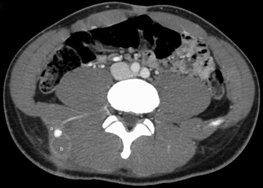 Contrast-enhanced CT scan of the lower abdomen and pelvis showing a single lobe of a presumed, bilobed pseudoaneurysm (a) as well as a 3.5 × 5.5 × 6 cm rim-enhancing, lobular collection of the superior right gluteal subcutaneous tissues, just superior to the right iliac crest and lateral to the paraspinal musculature, consistent with a hematoma (b).