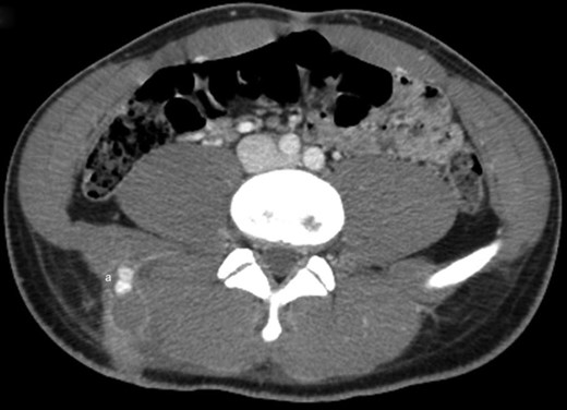 Axial cut from the same contrast-enhanced CT scan of the lower abdomen and pelvis showing a 1.6-cm bilobed, enhancing lesion, consistent with pseudoaneurysm, presumably extending from a branch of a right lumbar artery (a).