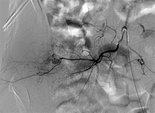 Digital subtraction angiography showing a small pseudoaneurysm originating from the peripheral aspect of the distal right lumbar artery (a).