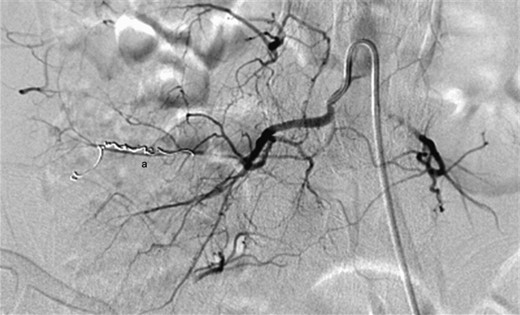 Digital subtraction angiography demonstrating successful embolization of the proximal and distal entry points of the pseudoaneurysm using platinum microcoils (a).