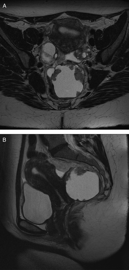 (A) Axial MRI image of pelvis demonstrating retrorectal cyst. (B) Sagittal MRI image of pelvis demonstrating retrorectal cyst.