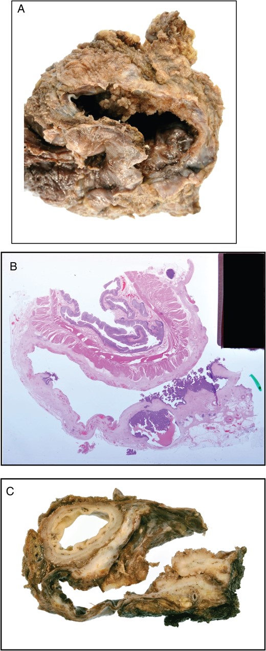(A) Pathological specimen demonstrating the cyst with transitional cell epithelium. (B) Pathological specimen demonstrating the cyst and rectum. (C) Histology demonstrating the cyst invading the rectum.