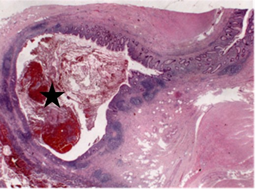 Small appendiceal diverticula with inflammation.