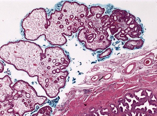 Overview of the gallbladder with tubular adenoma (25×, HE).