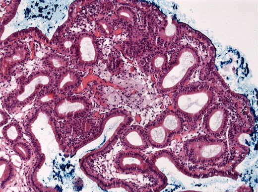 Gallbladder polyp in magnification (100×, HE).