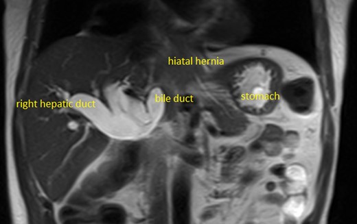 MRCP: biliary dilatation, kinking CBD on the hiatus.