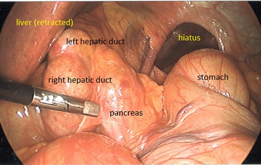 Intraoperative: pancreas seen herniated through hiatus. CBD dilated.