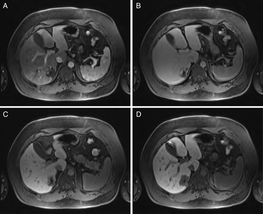 Sequential MRI imaging of hepatic hemangioma. Note delayed centripetal filling: (A) T1 arterial phase, (B) T1 60-s delay phase, (C) T1 postcontrast phase and (D) T1 hepatographic phase.