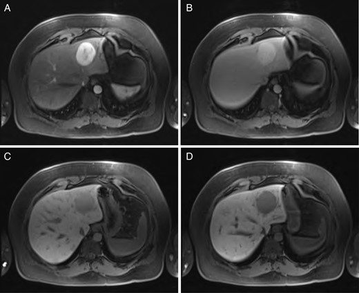 Sequential MRI imaging of HSFT: (A) T1 arterial phase, (B) T1 60-s delay phase, (C) T1 postcontrast phase and (D) T1 hepatographic phase.