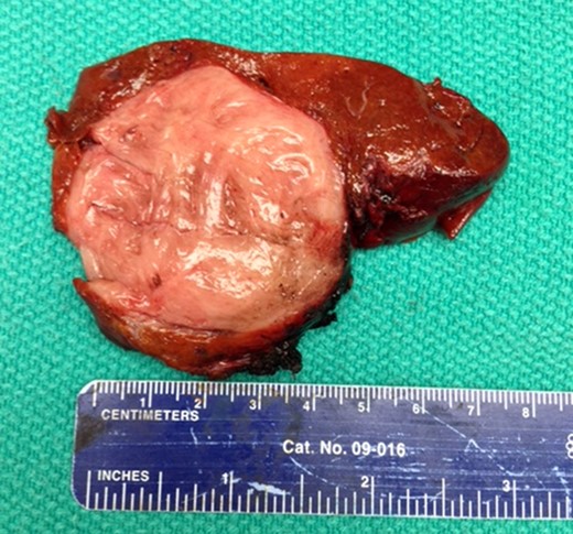 Gross appearance of HSFT. Note whorled appearance and normal surrounding parenchyma.