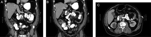 CT demonstrating LPDH.