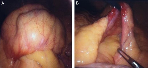 Intraoperative findings of LPDH.