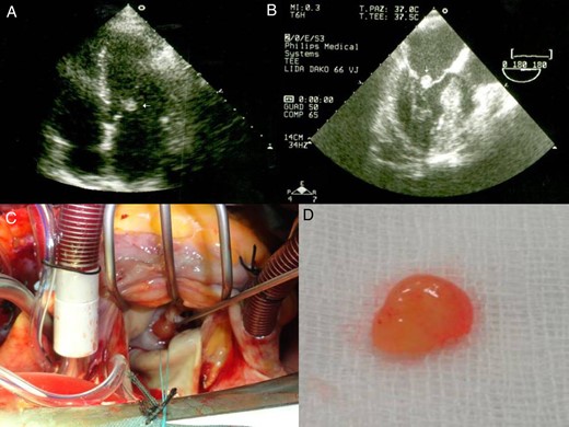 Transthoracic echocardiography shows a mobile and spherical mass of 1.0 cm in size attached to anterior mitral leaflet. Parasternal long-axis view (A) and an apical four-chamber view (B). Gross specimen of excised mass reveals a friable mass with frond-like surface.