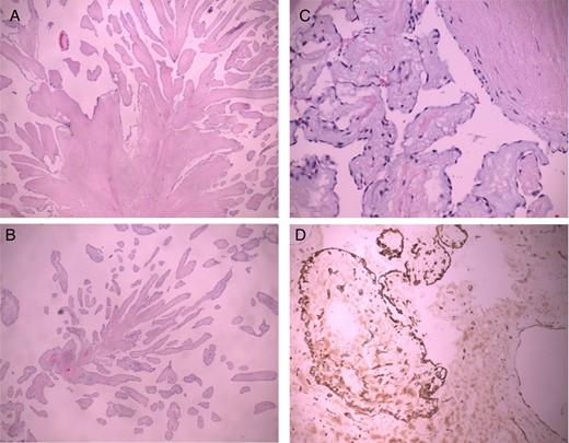 PFE. Low magnification demonstrates a papillary configuration of paucicellular fronds (A, B H-E 10×). A higher magnification demonstrates a myxoid papillary structure lined by endothelial cells that express endothelial cell markers (C H-E 40×, D CD 34 20×).