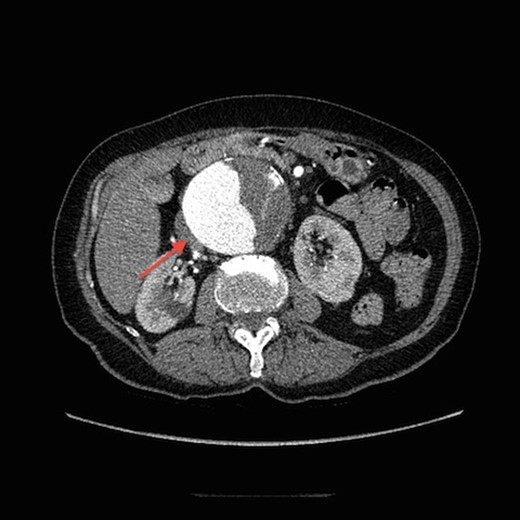 Transverse view of CT aortogram, showing compression of IVC (arrow).