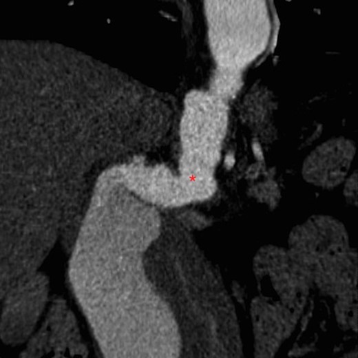 Tortuous angled neck of aorta on CT aortogram (asterisk).