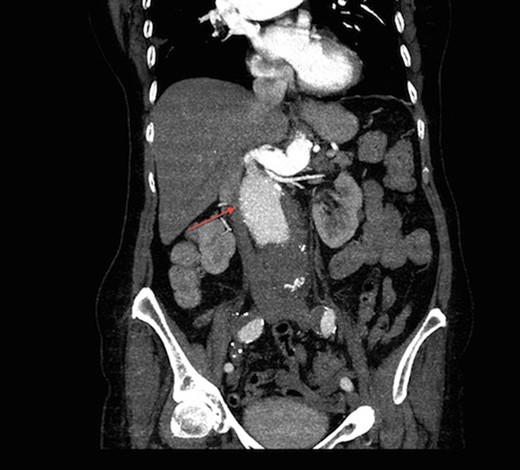 Coronal view of CT aortogram showing compression of IVC (asterisk).