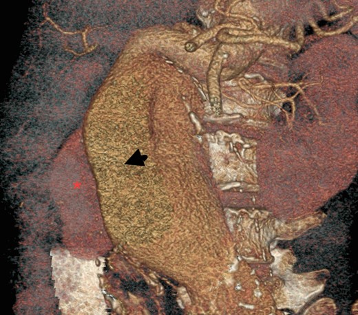 Three-dimensional construction of CT aortogram showing displaced and compressed IVC (asterisk) due to large AAA (arrow head).
