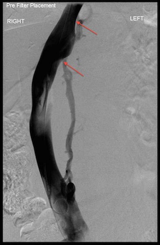 Venogram during IVC filter insertion showing indentation by AAA on IVC and its displacement (arrows).