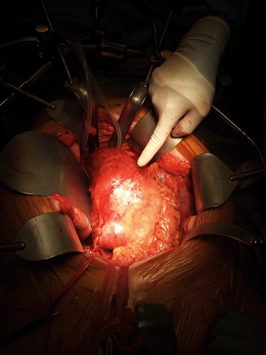 Intraoperative findings of large AAA.