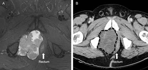 (A) This is a MRI T2-weighted image before neoadjuvant therapy. The light area clearly delineates the large heterogeneous mass in the right ischiorectal fossa. The rectum is displaced to the left. (B) This is a CT image of the same mass after neoadjuvant therapy, marked by dashed line.