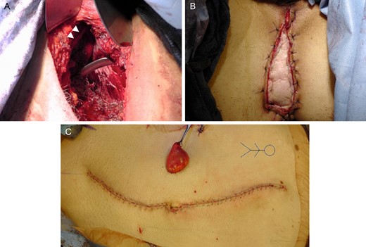 (A) Perineum wound after removal of specimen. White arrowheads mark the inferior pubic ramus. (B) Rectus abdominis myocutaneous flap reconstruction of the perineum. (C) Abdominal closure with end ileostomy. Rectus flap was harvested from the left side. Stick figure marks patient orientation.