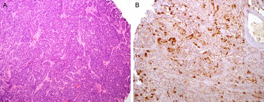Basaloid carcinoma of the anal canal. (A) Relatively small basaloid neoplastic cells arranging in a trabecular pattern, resembling cylindroma of the skin or adenoid cystic carcinoma. (B) Scattered tumor cells with p16 immunoreactivity.