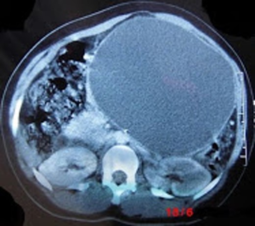 CT showing a large pancreatic pseudocyst in the body and tail of pancreas bulging into the anterior abdominal wall and displacing loops of the small bowel.