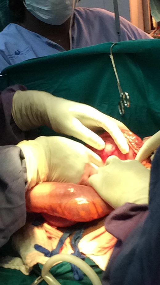 Mobilized bulging pancreatic pseudocyst with distended transverse colon inferiorly.