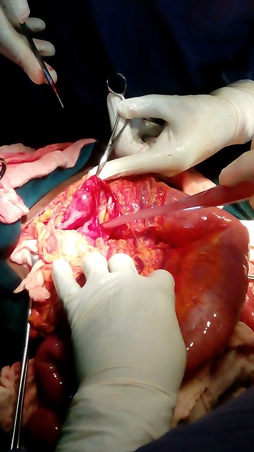 Cystostomy, aspiration and division of loculi.
