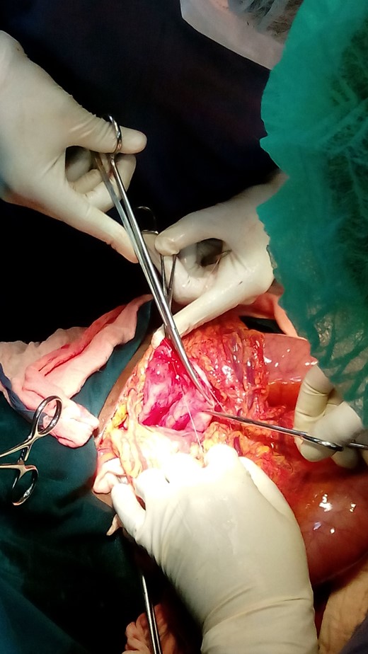 Approximation of long limb of Roux to the pseudocyst without tension.
