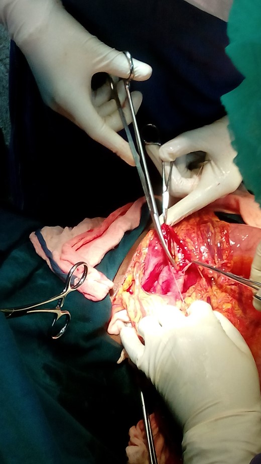 Cystjejunostomy.