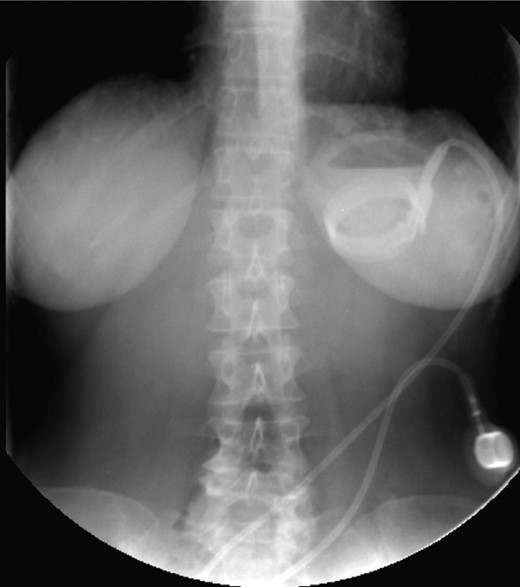 Posterior slippage of the ring.