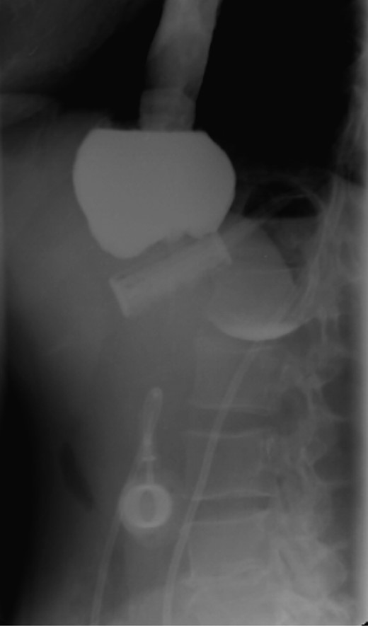 Water-soluble contrast shows a thin liquid passage downstream of the ring and marked gastric pouch distension.