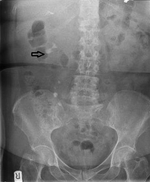 The XR-KUB showing a right lower pole staghorn calculus.