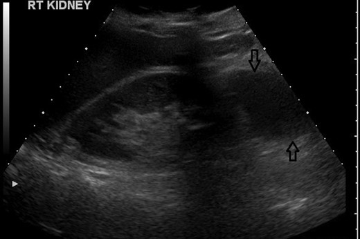 USS showing a suspected simple cyst on the lower pole of the right kidney.