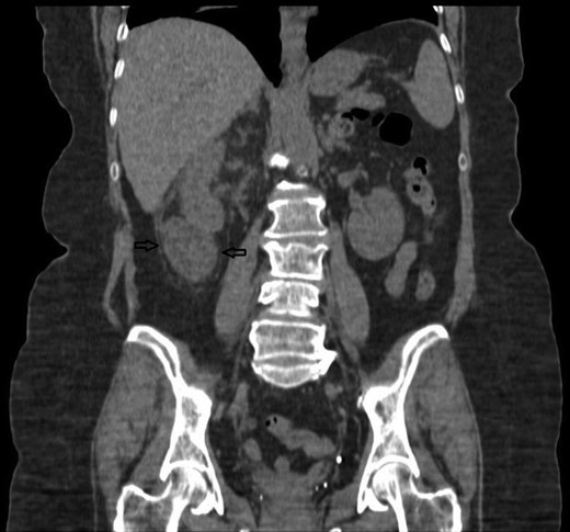 A non-contrast CT coronal view, showing the right kidney with a retroperitoneal collection associated with the lower pole. The stone is anterior to this CT slice.