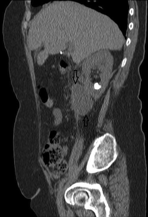 A CT sagittal view, showing the calculus in the lower pole calyx and the collection below the kidney.