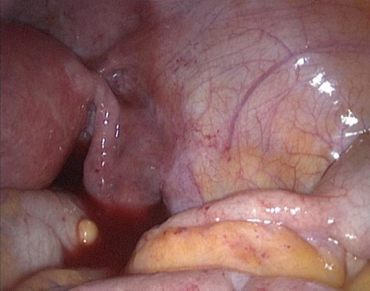 Intraoperative finding of hemoperitoneum as complication of appendicular endometriosis.