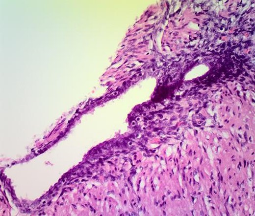 Histopathological examination of the appendix showing endometrial gland and stroma in its muscular tissue.