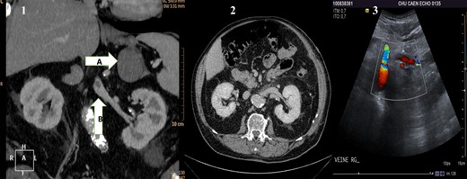 (1) Preoperative CT scan showing the adrenal mass (A) and in the renal vein a hypodense mass (B) corresponding to the renal vein tumor thrombus. (2) Postoperative CT scan showing the left kidney and its permeable vein. (3) Flow in the left renal vein on postoperative Doppler ultrasound.