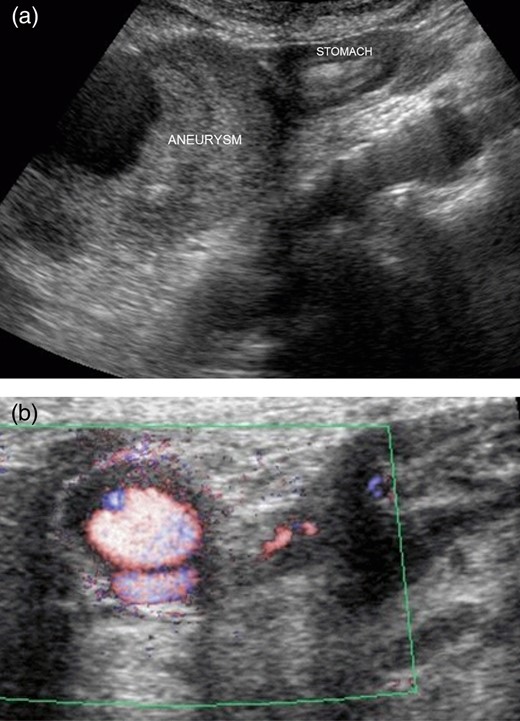 (a) Abdominal ultrasonography showed that the mass was present on the border of the greater curvature of the stomach. (b) Blood flow was observed inside the mass.